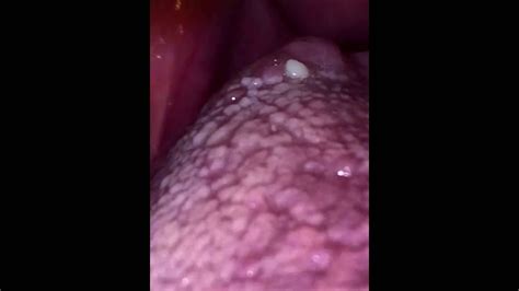 Coughing Up Tonsil Stones Youtube