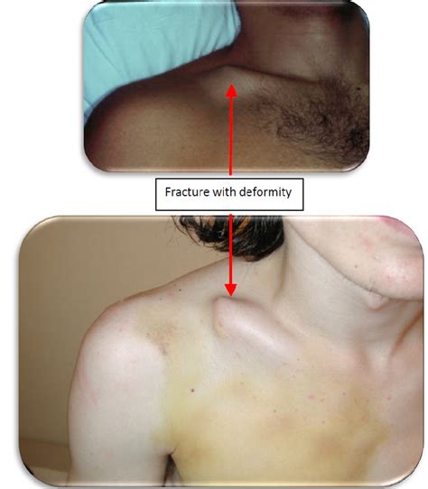 Clavicle Bone Fracture