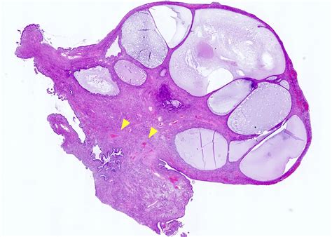 Pathology Outlines Nabothian Cysts