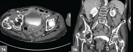 A 77-year-old woman with right hip fluid collection ...