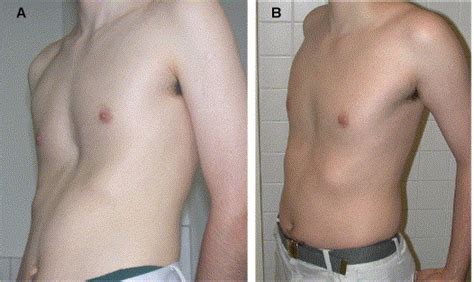 The Vacuum Chest Wall Lifter An Innovative Nonsurgical Addition To