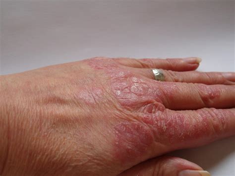 Psoriasis Skin Pictures Dorothee Padraig South West Skin Health Care