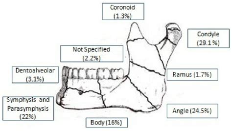 Mandibular Fracture Ppt