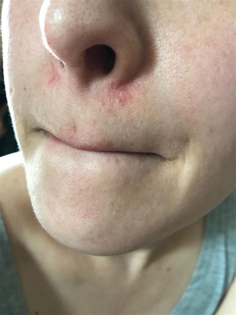 How To Get Rid Of Eczema Around Nose