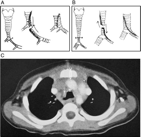 Aortopexy With Tracheal Reconstruction For Postoperative Tracheomalacia