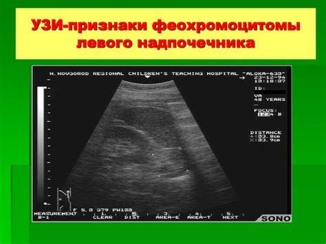 Заболевания надпочечников - презентация онлайн Картинка - Заболевания надпочечников - презентация онлайн
