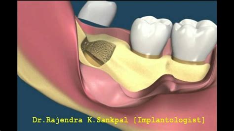 Surgical Extraction Of Wisdom Tooth Close To Nerves Youtube