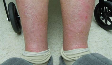 Natural Way To Eliminate Dermatitis Naet Dubai