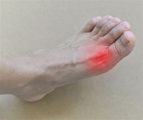 What Causes Gout In The Foot My Footdr