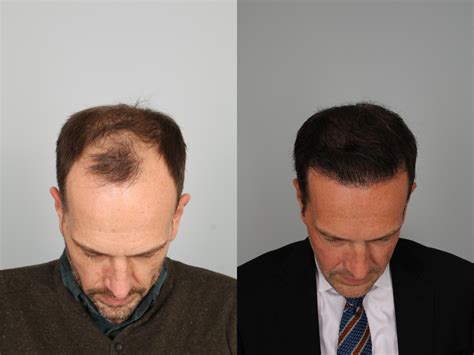 Neograft Hair Transplant Before After Photo Gallery Louisville Ky