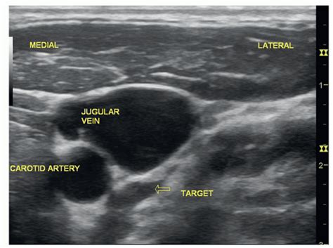 Ultrasound Guided Deep Cervical Plexus Block Anesthesia Key