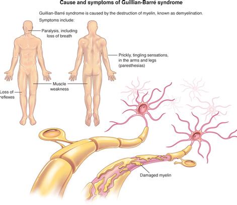 Afección rara por la que el sistema inmunitario del cuerpo ataca los nervios fuera del encéfalo y la médula espinal. Guillain-Barre syndrome can be a starting point to test ...
