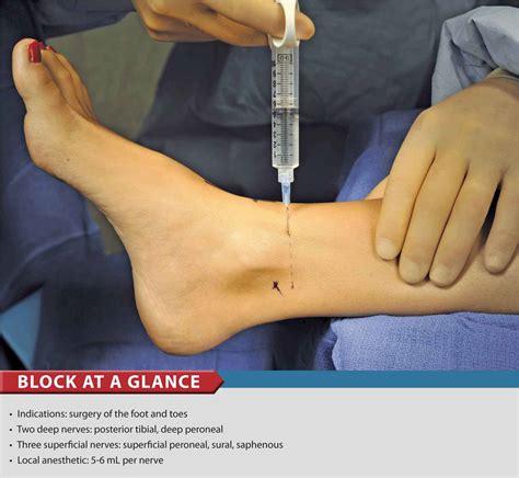 Ultrasound Guided Ankle Block