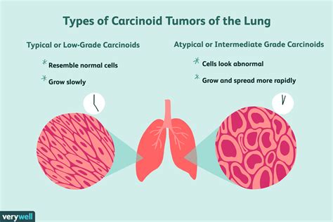 Carcinoid Lung Tumor Treatment More