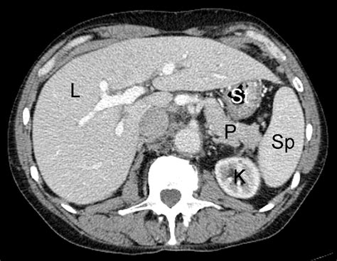 Example Of Normal Contrast Enhanced Abdominal Ct Scan In Human Patient