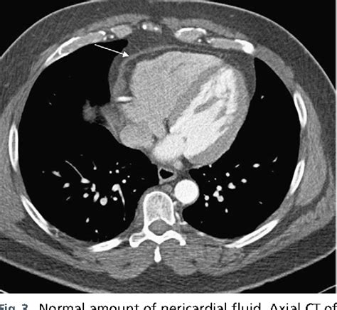 Figure 3 From Mr Imaging Of The Pericardium Semantic Scholar