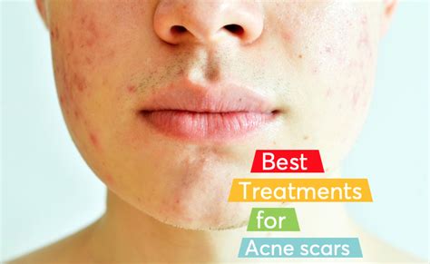 The Best Acne Scar Treatments According To Dermatologists Mdacne