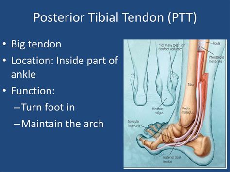 Posterior Tibial Tendon Tear Ankle