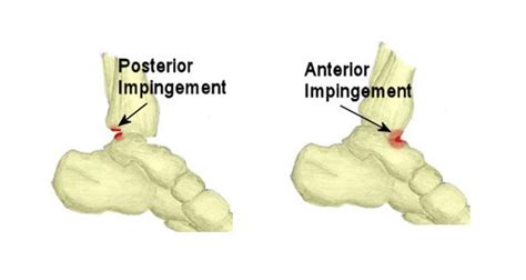Ankle Impingement Symptoms Causes Treatment And Rehabilitation
