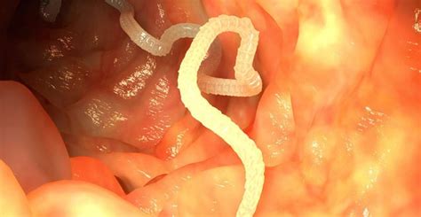 Tapeworm Cancer Develops Inside Colombian Mans Lungs Killing Him