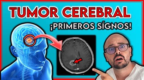 ¡estos Son Todos Los SÍntomas De Un Tumor Cerebral ¡signos De Alerta Youtube