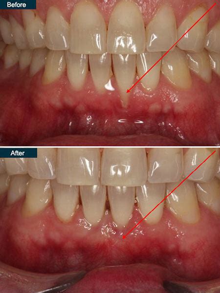 In dental speak, receding gums are a mucogingival what happens during gum grafting surgery? Gum Grafting NYC | Gum Surgery - New York Periodontist ...