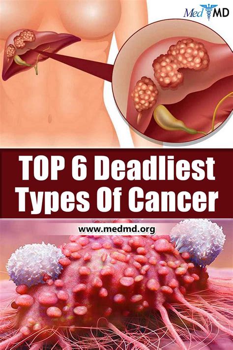 What Are The 10 Deadliest Cancers