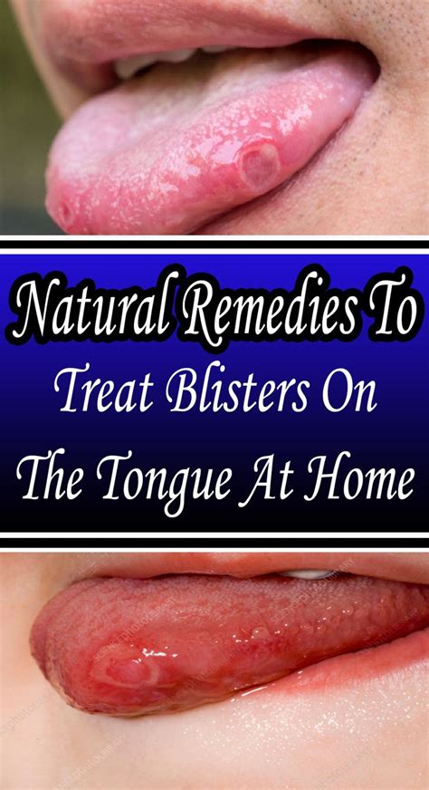 Characteristic Remedies To Treat Blisters On The Tongue At Homehealth