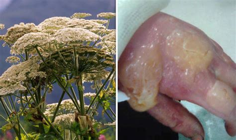 Giant Hogweed Warning Everything You Need To Know About Britains Most