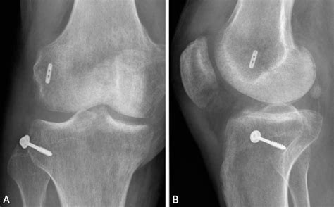 Combined Acl Reconstruction And Segond Fracture Fixation Fails To