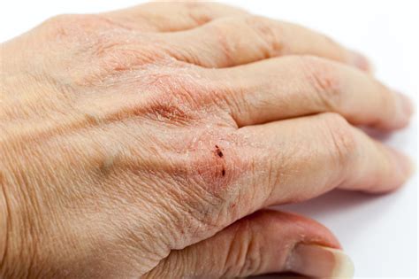 Prevent And Treat Dry Cracked Hands University Health News