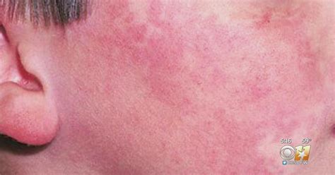 Rash Of Fifth Disease Making The Rounds In North Texas Cbs Texas