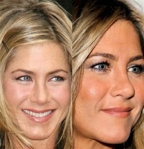 Priority Botox Nose Job Before And After References My Reff