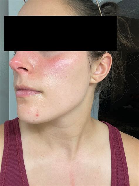 Skin Concerns Help With Redness On Cheeksnose Not From Acne R