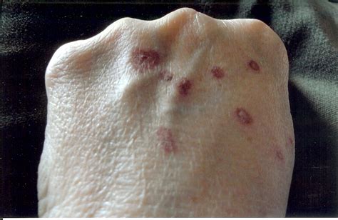 Red Spots On Back Of Hands Pictures Photos