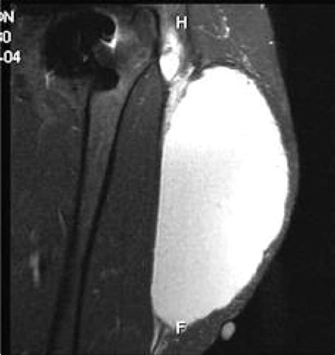 Case 1 Mri Scan Showing A Large Fluid Filled Cyst Communicating