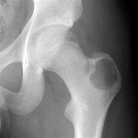 Unicameral Bone Cyst Probable Image