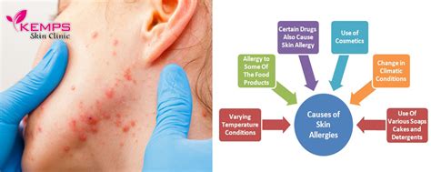 What Is The Root Cause Of Skin Allergies Kemps Skin Clinic