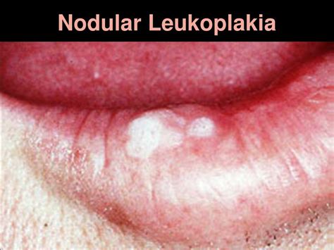 Ppt Non Neoplastic Diseases Of Oral Cavity Powerpoint Presentation