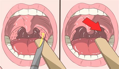 4 Effective Ways To Remove Tonsil Stones Without Surgery Healthy Food