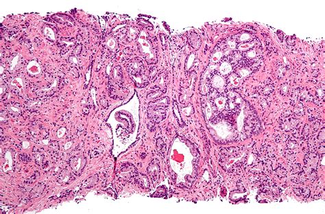 Fileprostate Cancer With Gleason Pattern 4 Low Mag Wikimedia Commons