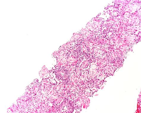 Pathology Outlines Eosinophilic Pneumonia