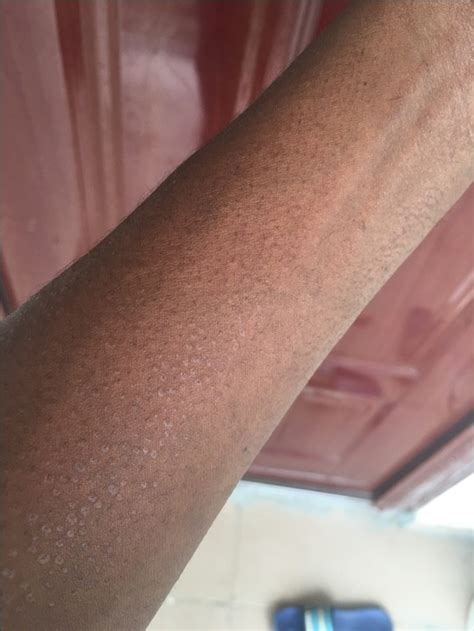 Strange Rashes On My Skini Need Help Health Nigeria