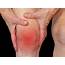 Rheumatoid Arthritis Treatment  Health Care Bin