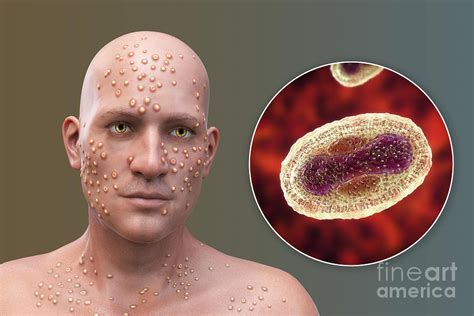 Smallpox Virus Infection Photograph By Kateryna Konscience Photo