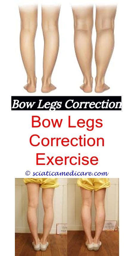Bowleggedness in most children will correct itself, so parents should not force babies to. Bow Legged (Görüntüler ile) | Bacaklar