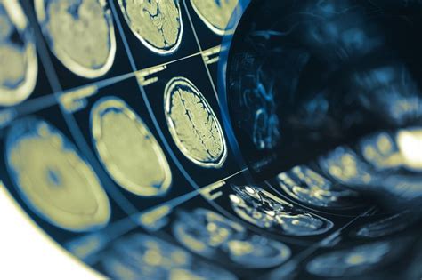 Covid 19 Is Tied To Deadly Brain Inflammation In Some Patients Live