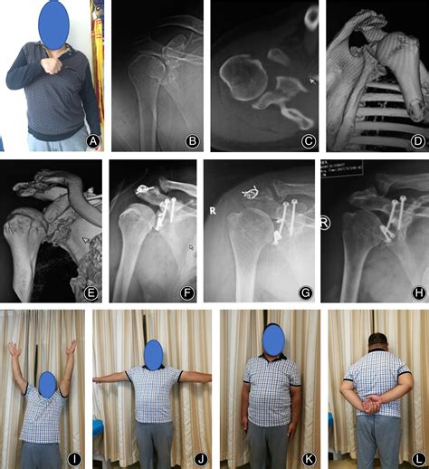 Treatment Of Chronic Anterior Shoulder Dislocation By Coracoid