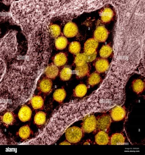 Micrografía Electrónica De Transmisión De Partículas Del Virus Sars Cov