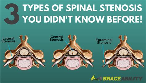 Are Central Foraminal And Lateral Spinal Stenosis All Different